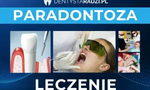 Grafika przedstawia leczenie paradontozy: ilustrację zęba z ubytkami kostnymi, zabieg laserowy i stomatologiczne procedury.