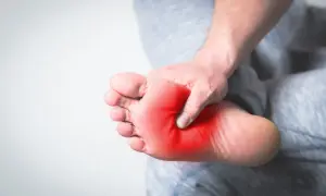 Ból stopy, czerwony obszar na podeszwie sugeruje zapalenie rozcięgna podeszwowego.