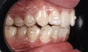 Zbliżenie na zęby z widocznym aparatem Invisalign. Przezroczyste nakładki delikatnie korygują ułożenie zębów, zapewniając dyskretną korektę zgryzu.