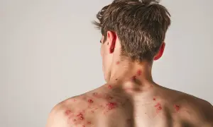 Pleśniawki po antybiotyku na karku i plecach młodego mężczyzny. Widoczne czerwone, zapalne zmiany skórne.