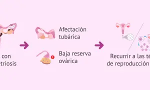 Ilustración muestra cómo la endometriosis puede afectar las trompas y ovarios, llevando a la necesidad de técnicas de reproducción asistida para el embarazo.