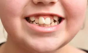 Uśmiech dziecka z krzywo rosnącymi zębami stałymi. Widać nierówno ustawione jedynki i pozostałe zęby.