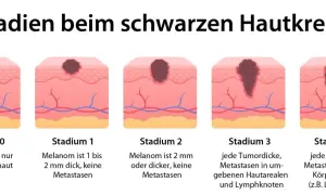 Illustration zeigt Stadien von schwarzem Hautkrebs. Symptome reichen von frühen Tumoren in der Oberhaut bis zu Metastasen in entfernten Körperregionen.