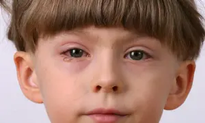 Oko dziecka zaczerwienione, z widoczną wydzieliną, objawy zapalenia spojówek u dzieci.