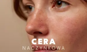 Zbliżenie na twarz z widocznymi rumieńcami i drobnymi naczynkami. Tekst: CERA NACZYŃKOWA.