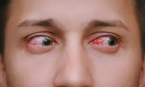 Ojos rojos e irritados, señal de que la conjuntivitis es contagiosa.