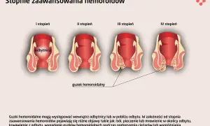 Hemoroidy: Do jakiego lekarza i kiedy szukać pomocy?
