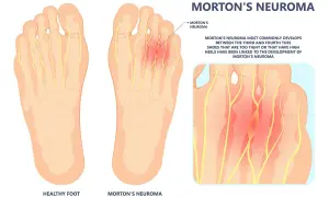 Illustration zeigt gesunde Fußsohle und Morton-Neurom. Selbsthilfe bei Morton-Neurom durch passende Schuhe ist wichtig.