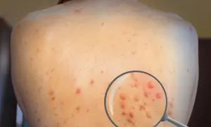 Plecy osoby z licznymi, czerwonymi wykwitami skórnymi, powiększonymi pod lupą.