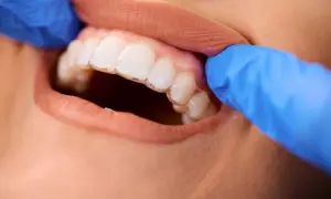 Dentyści w niebieskich rękawiczkach poprawiają przezroczysty aparat ortodontyczny, korygując zgryz otwarty.