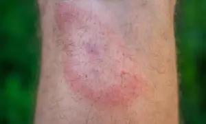 Rote, juckende Stelle am Bein nach einem Zeckenbiss. Wann zum Arzt? Informieren Sie sich über Symptome und Behandlung.