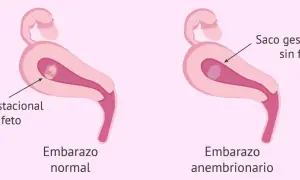 Ilustración comparativa de un embarazo normal con saco gestacional y feto, y un embarazo anembrionario con saco gestacional sin feto. Experiencias de embarazo anembrionario.
