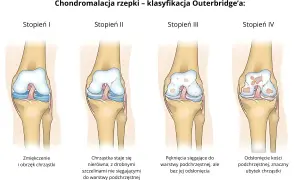Ilustracja przedstawia cztery stadia chondromalacji rzepki wg klasyfikacji Outerbridge'a, od łagodnego do zaawansowanego.
