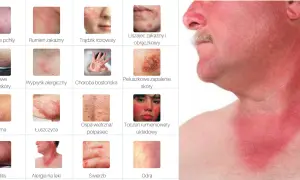 Jak wygląda alergia skórna zdjęcia – poznaj objawy i ich wygląd