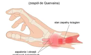 Ilustracja anatomiczna dłoni z zaznaczonym zapaleniem pochewek ścięgnistych kciuka.