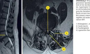 MRT-Aufnahmen der Lendenwirbelsäule zeigen eine Spondylolisthese L4/5, die auf Osteochondrose LWS hindeutet. Verdicktes Ligamentum flavum verengt den Spinalkanal.