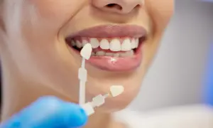 Dobór koloru licówek do naturalnych zębów. Na ile zębów zakłada się licówki? Decyzja należy do pacjenta i dentysty.
