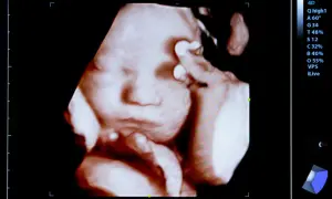 Trójwymiarowe USG pokazuje twarz dziecka, które wygląda, jakby miało zaraz zapłakać. Dziecko w brzuchu płacze?