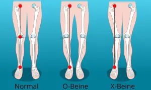 Vergleich von normalen Beinen, O-Beinen und X-Beinen. Die Darstellung zeigt die Knochenstruktur und die Ausrichtung der Gliedmaßen.