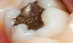 Zbliżenie na ząb z ciemną, metaliczną plombą amalgamatową. Widać drobne pęknięcia i nierówności na powierzchni plomby.