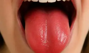 Lingua rossa e liscia, possibile sintomo di carenza vitamina b12.