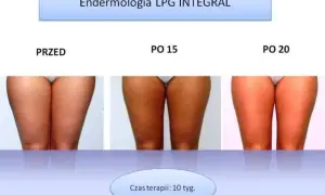 Endermologia: dla kogo? Kiedy warto, a kiedy unikać zabiegu?