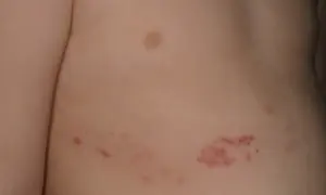 Barnets hud visar ett utslag med röda prickar och blåsor, troligen bältros.