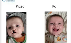 Uśmiechnięte dziecko przed i po korekcie rozszczepu podniebienia. Widoczna poprawa wyglądu twarzy.