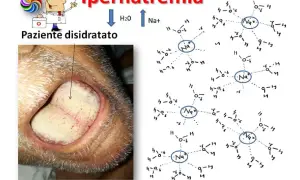Lingua: Italiano

Ipernatremia: paziente disidratato con lingua secca e patinata, indicativo di sodio alto. Le molecole di Na+ circondate da H2O illustrano la condizione.