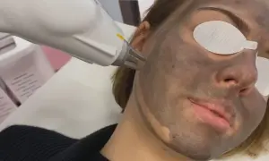 Zabieg laserowy z maską węglową. Skóra twarzy pokryta ciemną maską, oczy osłonięte.