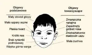 Ilustracja przedstawia twarz dziecka z zaznaczonymi objawami: mały obwód głowy, płaska twarz, krótki nos, wąska górna warga, zmarszczka nakątna, zapadnięty grzbiet nosa, zniekształcenie małżowin uszu.