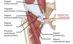 Anatomia pachwiny z zaznaczonym miejscem bólu i uszkodzenia. Ilustracja pokazuje mięśnie brzucha, biodrowo-lędźwiowy, krawiecki oraz pierścień pachwinowy.