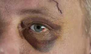 Ein blaues Auge mit einer kleinen Wunde auf der Stirn. Die Heilung dauert seine Zeit, aber das Auge wird wieder normal.