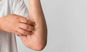 Czy biotyna uczula? Objawy alergii, które warto znać