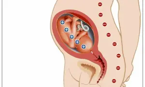 Płód z antygenami Rh+ w macicy matki Rh-. Ilustracja pokazuje potencjalny konflikt serologiczny.