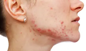 Skuteczne sposoby na pryszcze na twarzy - uniknij frustracji i blizn