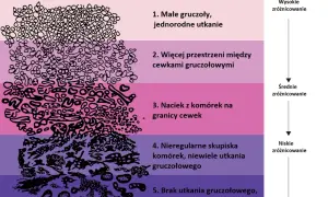 Skala Gleasona ilustruje wyniki biopsji prostaty, pokazując stopnie zróżnicowania komórek od 1 do 5.