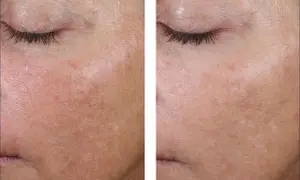 Comparaison avant/après : peau avec rougeurs et irrégularités, puis peau plus lisse et uniforme, peut-être grâce au retinol ou acide hyaluronique.