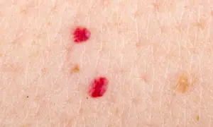 Zbliżenie na skórę z kilkoma czerwonymi pieprzykami i innymi zmianami.