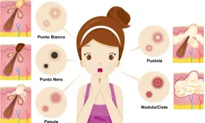 Ragazza preoccupata per i brufoli: punto bianco, punto nero, papula, pustola e nodulo/cisti illustrati.