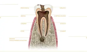 Przekrój zęba z widoczną próchnicą, martwą miazgą i zmianą okołowierzchołkową. To ilustracja wyjaśniająca, endodoncja co to jest.