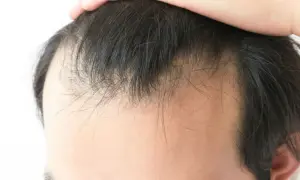 Primer plano de la línea del cabello de un hombre, mostrando adelgazamiento y entradas. Una mano toca la parte superior de la cabeza, quizás preguntándose porque los hombres se quedan calvos.