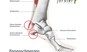 Anatomische Darstellung des Fußes mit Fokus auf Fersenschmerzen. Die Achillessehne und der Wadenmuskel sind sichtbar. Rote Kreise markieren Schmerzbereiche an der Achillessehne und der Plantarfaszie.