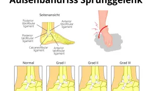 Illustration zeigt einen Bänderriss am Sprunggelenk, mit Fokus auf das ligamentum fibulotalare anterius und verschiedene Schweregrade.