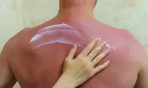Eine Hand trägt Salbe auf einen stark sonnenverbrannten, roten Rücken auf.