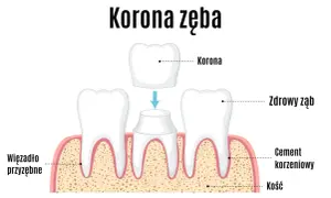 Ilustracja pokazuje odbudowę korony zęba. Nowa korona jest umieszczana na przygotowanym zębie, zapewniając mu pełną funkcjonalność i estetykę.