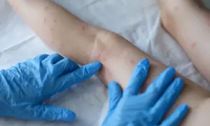 Ręce w niebieskich rękawiczkach badają skórę z czerwonymi kropkami, które mogą być bliznami po ospie.