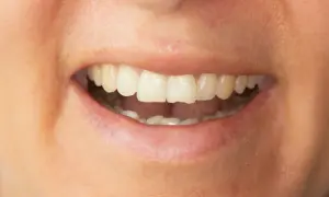 Uśmiech z widocznymi zębami. Gdy ząb się kruszy, warto skonsultować się z dentystą.