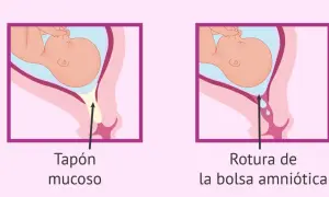Ilustración comparativa: tapón mucoso y rotura de la bolsa amniótica, señales del parto en la semana 37.