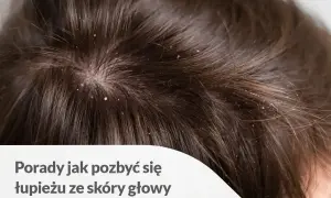 Widoczne białe płatki na ciemnych włosach, wskazujące na problem z łupieżem. Porady jak pozbyć się łupieżu ze skóry głowy.